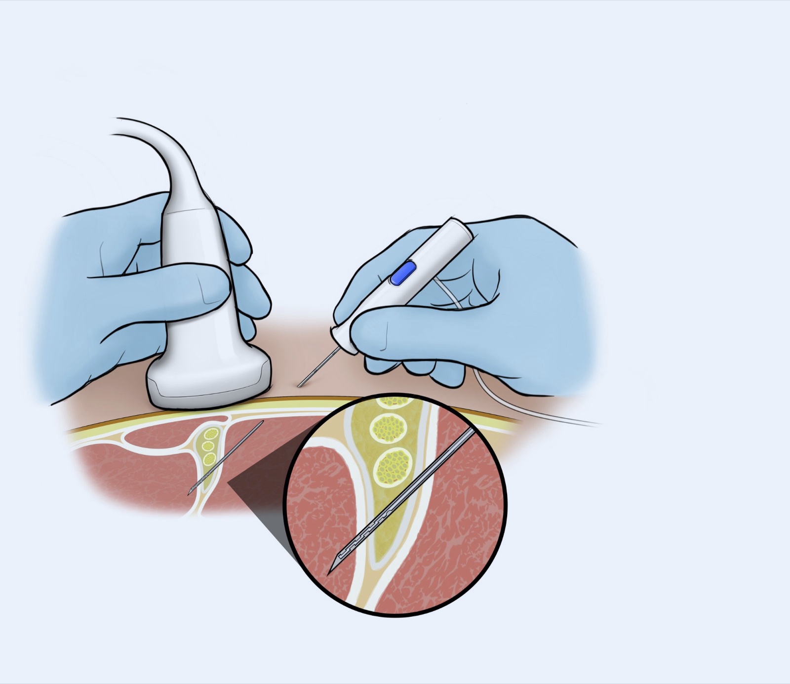 Illustration: one hand holds the ultrasound probe while the other guides the Nordstar needle to the nerve; a close-up shows the needle tip beside the nerve