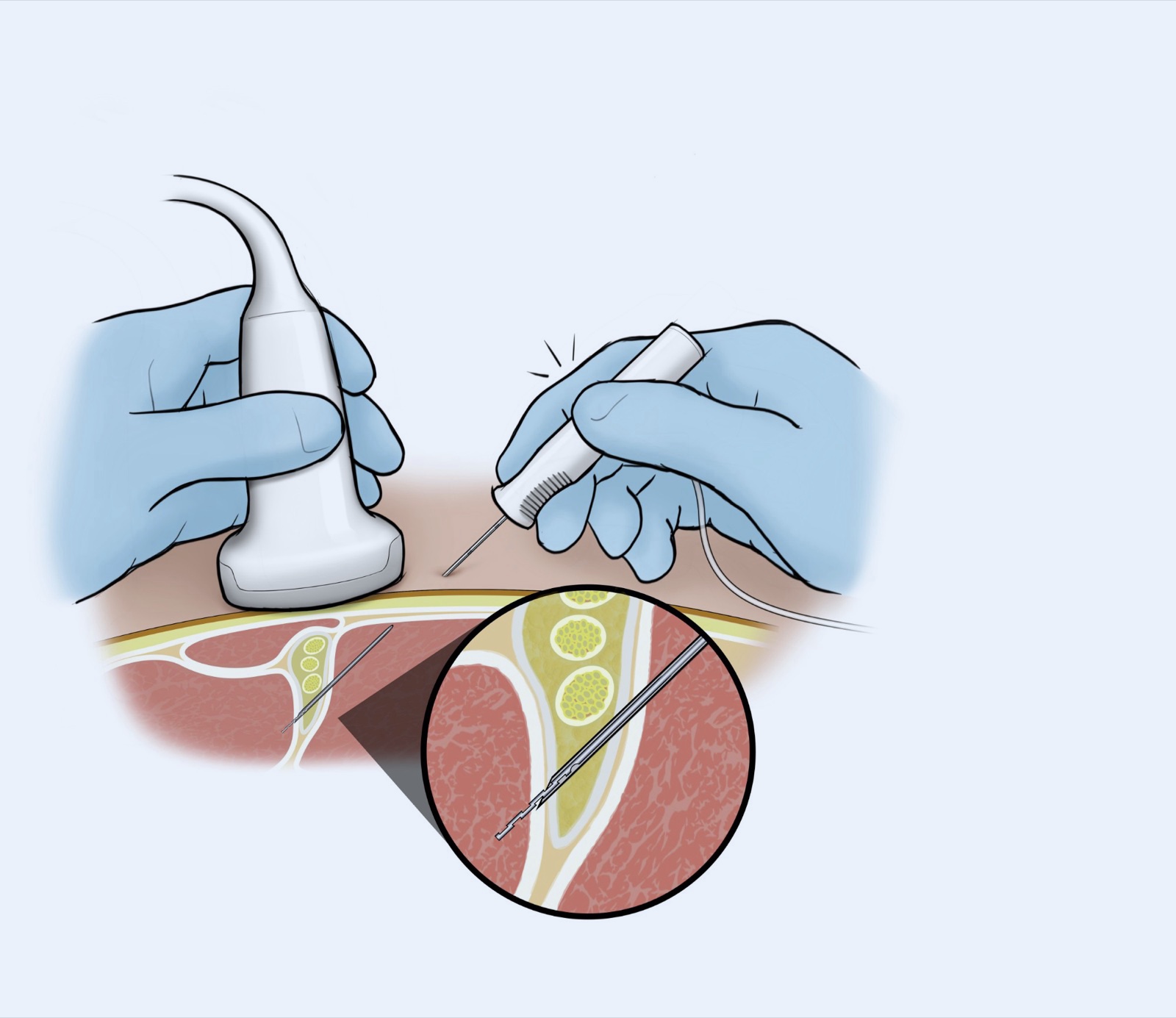 Illustration: the clinician presses the button on the device; the close-up shows the catheter being placed from the needle tip at the nerve