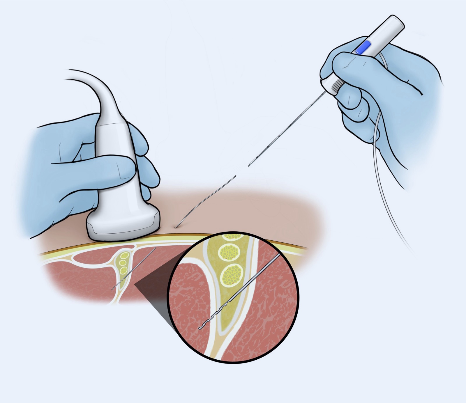 Illustration: the needle is withdrawn, leaving the catheter in place; the close-up shows the catheter tip staying in place at the nerve